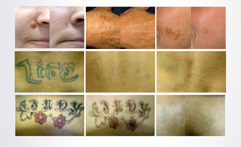 Approvazione CE Laser Beauty Equipment rimozione del tatuaggio q commutato e prezzo yag lase